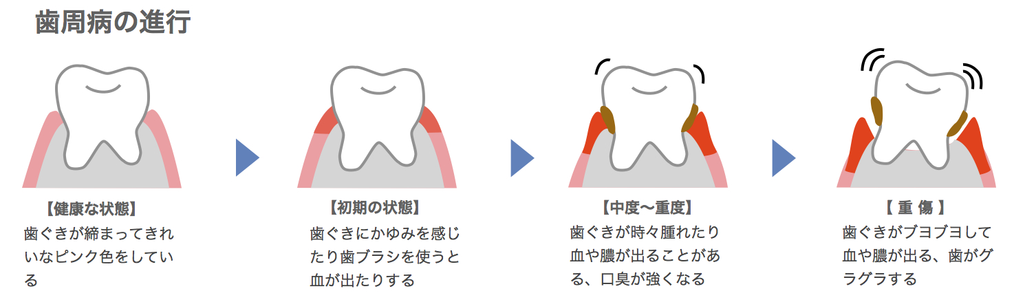 歯周病の進行具合の図式