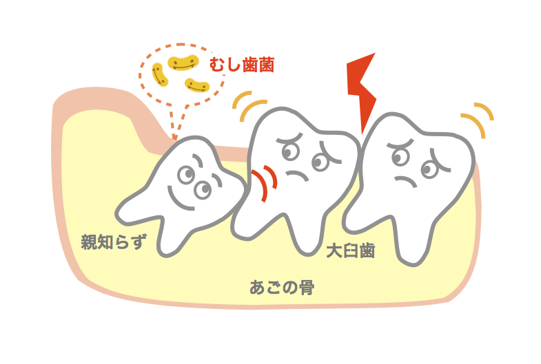 親知らずの図