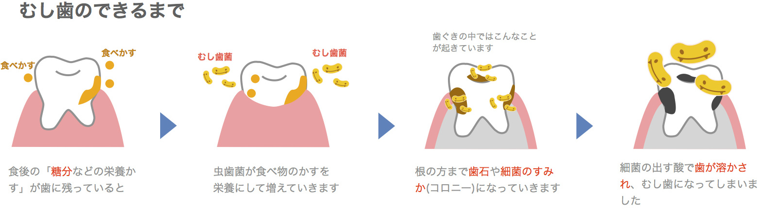 う蝕のできかた図